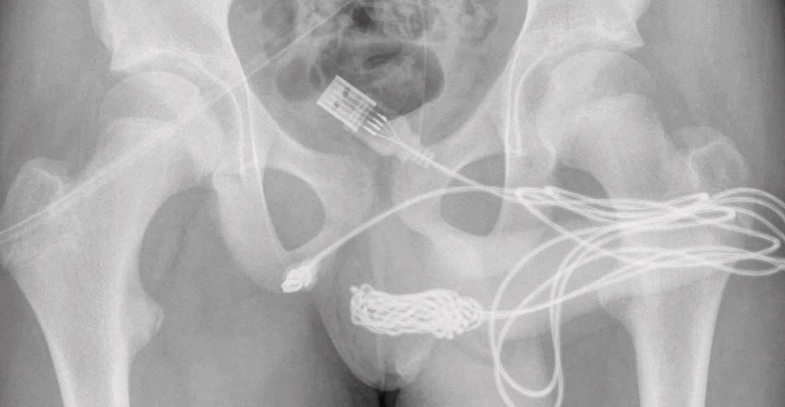 ¡¿Por?! Joven se introduce un cable USB en el pene y termina en el hospital