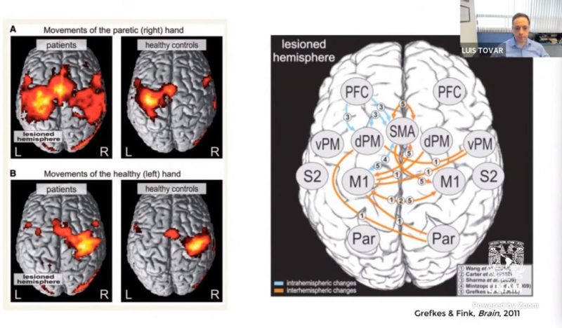 Cerebro infarto cerebral estudio