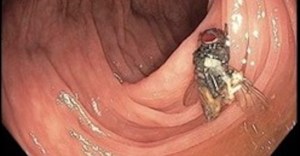 Encuentran mosca intacta en el colon de un hombre