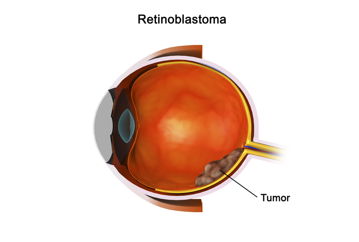 #RetratosQueSalvan: La campaña para detectar el cáncer ocular a través de una foto